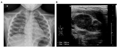 Kawasaki Disease With Combined Cholestatic Hepatitis and Mycoplasma pneumoniae Infection: A Case Report and Literature Review